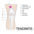 Tendinitis knee injury Royalty Free Stock Photo