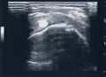 Tendon muscle ultrasound sonography