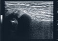 tendon muscle ultrasound sonography