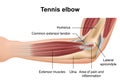 Tennis elbow injury medical illustration on white background