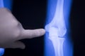 Tennis elbow joint xray scan