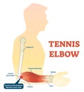 Tennis elbow medical fitness anatomy vector illustration diagram with arm bones, joint and muscles.