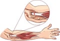 Tennis elbow - tear in the common extensor tendon of the arm