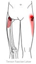 Tensor Fasciae Latae: Managing pain arriving from myofascial trigger points in the Tensor fasciae latae muscle