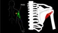 Teres minor muscle. Trigger points and referred pain in the arm and shoulder