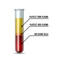 Test tube filled with blood after centrifuge for PRP injection procedures. Platelet-rich plasma laboratory equipment.