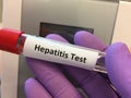 Test tube for Hepatitis virus blood testing