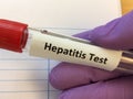 Test tube for Hepatitis virus blood testing