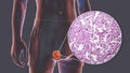 Testicular cancer, 3D illustration