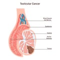 Testicular cancer. Pathological malignant tumor develops in the testicles. Royalty Free Stock Photo