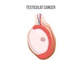 Testicular cancer vector illustration