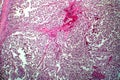 Testicular seminoma, light micrograph