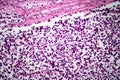 Testicular seminoma, light micrograph