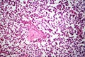 Testicular seminoma, light micrograph