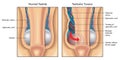 Testicular torsion