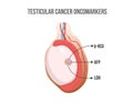 Testis tumor markers. Testicular cancer releasing hormones and enzymes