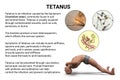 Mechanism of tetanus disease, 3D illustration