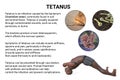 Mechanism of tetanus disease, 3D illustration