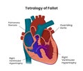 Tetralogy of Fallot composition of the heart defects. Vector illustration of the congenital heart anomaly Royalty Free Stock Photo