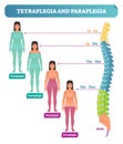 Tetraplegia and paraplegia spinal neural disorder medical vector illustration diagram with female back bone cross section.