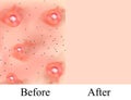 Texture, inflamed pimples and acne. Before After acne cysts. Skin background. Infographics. Vector illustration on Royalty Free Stock Photo