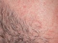Texture of irritated reddened male neck skin covered with hair and bristles Royalty Free Stock Photo
