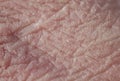 texture of pink unhealthy chapped human skin covered with deep wrinkles and dry scales and cracks