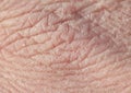 Texture of pink weather-beaten human hand skin covered with deep wrinkles and dry scales