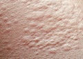 Background of the texture unhealthy irritated human skin is covered with fine wrinkles ,cracked and blistered from the burn and