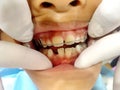 A Thai boy with Diastemas teeth problem onthe dental unit waitng to see the dentist in Hua Hin, Thailand April 1, 2018 Royalty Free Stock Photo