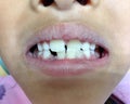 A Thai boy with Diastemas teeth problem onthe dental unit waitng to see the dentist in Hua Hin, Thailand April 1, 2018 Royalty Free Stock Photo