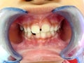 A Thai boy with Diastemas teeth problem onthe dental unit waitng to see the dentist in Hua Hin, Thailand April 1, 2018 Royalty Free Stock Photo