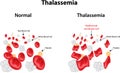 Thalassemia