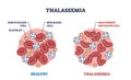 Thalassemia blood disorder caused by lack of hemoglobin outline diagram Royalty Free Stock Photo