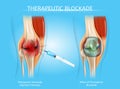 Therapeutic Blockage with Injection Therapy Vector Royalty Free Stock Photo