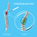 Therapeutic Blockage of Spine Diseases Vector Royalty Free Stock Photo