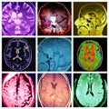 Brain different pathology colorful collage