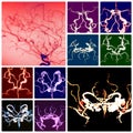 Atherosclerotic brain vessels colorful collage