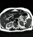 Cholangiogram gallbladder stones cholecystosis mri