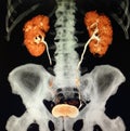 Modern ct urogram colorful structure kidneyes