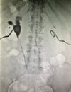 Xray nephrostomy contrast kidney position control