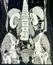 Modern ct scan of renal hydronephrosis pathology