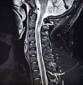 MRI lesion cervical part dangerous pathology Royalty Free Stock Photo