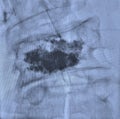 Lumbar pain treatment radiofrequency ablation