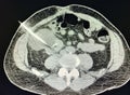 Ct scan right renal cyst guided drainage imaging