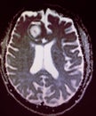 Brain meningioma headache mri examination