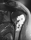 Large chondroid lesion mri examination