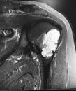 Large chondroid lesion mri examination