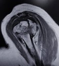 Mri shoulder fracture bone exam