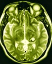 Brain cavernous malformation pathology mri exam